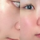 남악-1 | 목포 피부관리 고주파케어 후기 남악 본담에스테틱 모공관리 1회만에 모공축소 극대화