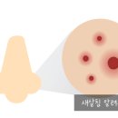 [공지] [로담한의원] 오래된 코흉터 새살침 치료 후기