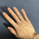 260524 내돈내산 손바닥 사마귀 치료 9일차 후기