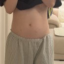 천안 드림아이 난임병원 시험관 시술 후기 난자채취 후 복수(사진 비교)