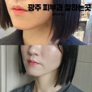 200 | 광주 피부과 잘하는 곳 올타이트 200샷 후기