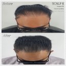 스칼프K 이미지