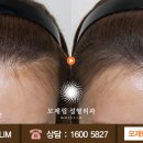 헤어라인 이미지