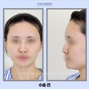 다듬성형외과의원 | 매부리코 실리콘 없이 비중격연골로 개선한 후기