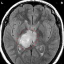 뇌 - 시상과 시상하부 thalamus / hypothalamus 이미지