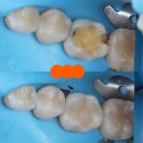 교대사랑이치과의원 | 교대역 치과 보철 아래 2차 충치를 다시 레진으로