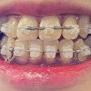 범어스카이치과교정과치과의원 | 치아교정일기 3년차 전편 모아보기 10개월 차부터 기록 교정 변화 모아보기