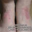 연세피부과의원 | 겨울철 핫팩 저온화상 상처 50일 기록ㅣ물집 흉터 메디폼 듀오덤 춘천 연세미라클의원