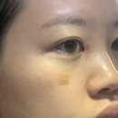 명동고운세상피부과의원 | 내돈내산 눈 옆 사마귀 레이저 제거 후기｜얼굴 사마귀 제거 비용 | 명동고운세상피부과