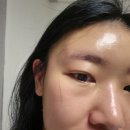 강남역 포텐자 여드름흉터피부과 캐비어리빌더 후기