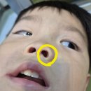 둘째가 코에 옥수수를 넣어서 응급실 다녀왔습니다ㅋㅋ 이미지