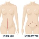 요즘 용어---- 알고나 지냅시다--9--로봇 수술===다빈치 로봇 수술기--암수술에 적용 이미지