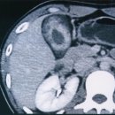 GB Adenomyomatosis 담낭 선근종증 이미지