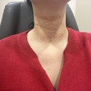 신논현 목주름필러 예쁨목주사 쁨의원 후기! 20대 선천성 가로주름 고민 해결