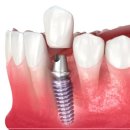 은평장수플란트치과의원 | 은평구치과 임플란트 식립 고민이라면