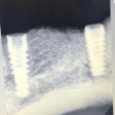 늘편안하내과의원 | 수지 치과 추천 , 당뇨 임플란트 과연 불가능할까요