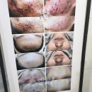 안성피부관리 믈리에스킨 안성점에서 하이플라듀얼로 플라즈마 피부살균관리 받고 온 후기
