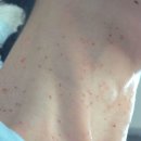 에이스한의원 | 창원 편평사마귀 무제한 성지 <하늘체한의원> 내돈내산으로 다녀온 중기