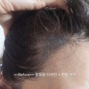 (인천 청라) 대표원장 직접시술 더이녹스칼프 헤어라인 내돈내산 후기