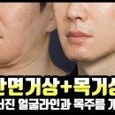 무너진 얼굴라인을 매끈하게! 안면거상+목거상 디테일 전후비교 영상 이미지