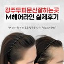 광주두피문신잘하는곳, M자 헤어라인 자연스럽게 달라진 실제 후기