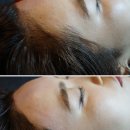 모모헤어라인 이미지