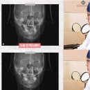 미소핀의원 | 돌출입전후 양악 윤곽 후기 얼굴비대칭병원