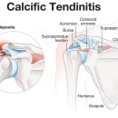 연세척척재활의학과의원 | 어깨 석회성건염의 원인·증상·진단·재활 치료 및 오십견과의 차이점 정리