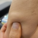 [첫 번째 방문]대전 지방종 피지낭종 제거 병원 연세화사외과 첫 방문 후기