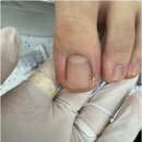 네일리케 | 화성 동탄 내성발톱 어린이 내성발톱은 무드비네일 페디크루 화성동탄점 가보세요