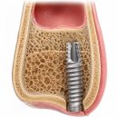 경로치과의원 | 인계동 치과 , 상악동 임플란트 꼭 필요할까요