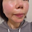 내돈내산 방문한 압구정피부과 온다리프팅+빼주라주사 리얼후기