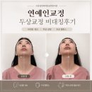 수원안면비대칭교정 한의원에서 받은 턱관절 교정 내돈내산 후기