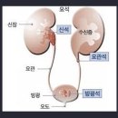 요로결석 증상 이미지