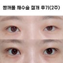 첫수 | 쌍수 재수술 절개 후기 1편 : 첫수 매몰 풀림, 짝짝이 쌍꺼풀 짝눈, 병원 상담 내돈내산