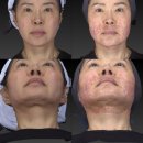 M코어빌딩 | 이중턱 고민, 엘라코어 리프팅 시술 후기 | 허준원M.D.피부과