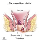 한창약품(주) | 혈전성 외치핵 : 논문으로 알아보자 [증상 / 치료 / 수술 / 비수술적 치료(자연치료) / 재발]