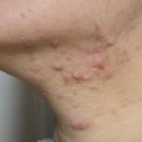 진해왁싱매료뷰티 | 지옥에서 온 여드름 피부의 진해 매료뷰티 천방케어 내돈내산 후기