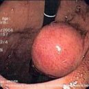 gastric body 의 huge mass 와 liver metastatic lesion 이미지