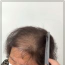 합정탈모관리 일산두피관리 여성 정수리 탈모 고민이라면! 자신감을 되찾아주는 메이두 두피커버 시술 후기
