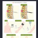 복합부위통증증후군[Complex Regional Pain Syndrome]의 증상 이미지