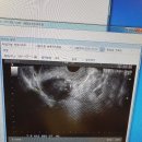 생리통 개빡 자궁근종 미레나 부작용(미레나실비가능)