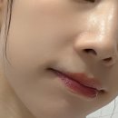 힐러 - 남구 신정로 35 | 깐달걀피부 만들기 홍대피부과 리쥬란힐러 후기
