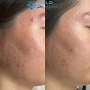 콜드플라즈마 이미지