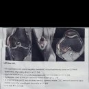 mri(첨부) 질문드려요.. 내측인대 부분파열 회복기간 이미지