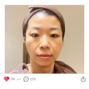 딜라이트피부과의원 | 트라넥삼산 트라넥산삼 주사 신논현역 피부과 딜라이트피부과 후기