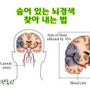 숨어 있는 뇌경색 찾아 내는 법 이미지