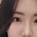 튜닝기록01_결막모반 제거 일주일 후기