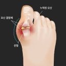 급성 통풍 증상 원인 요산수치 낮추는 좋은 음식 추천 이미지