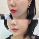 굿볼&스킨헬스 | 앞볼 옆볼꺼짐 올리디아 볼륨 스킨부스터 킨텍스피부과에서 받고 온 후기
